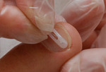 лечение вросшего ногтя пластинами