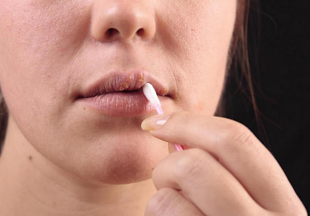 Простуда в уголках губ как лечить в домашних условиях
