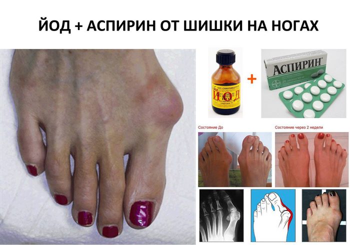 Вылечить косточку на ноге в домашних условиях