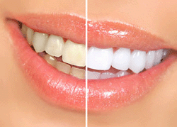 white_teeth_01  (250x179, 30Kb)