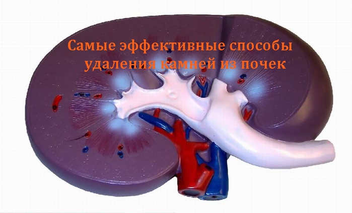 alt=      /2835299_Samie_effektivnie_sposobi_ydaleniya_kamnei_iz_pochek (700x424, 165Kb)