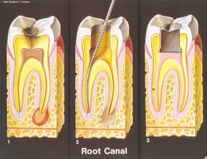 rootcanal-300x231 (300x231, 25Kb)