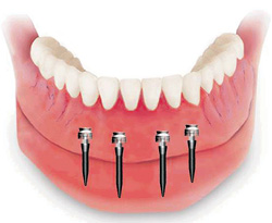Восстановление зубов за три дня (5) (250x205, 17Kb)