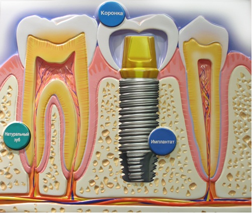 3925073_implant3 (501x423, 412Kb)