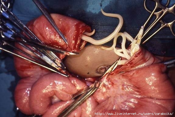 5708540_Ascaris_infection_Difficult_intestinal_anastamosis__joining_up_of_two_ends_clearly_if_we_cut_out_a_section_of_bowel_were_left_with_two_ends_that_need_to_be_joined_up_South_Africa_15806559973 (575x385, 125Kb)
