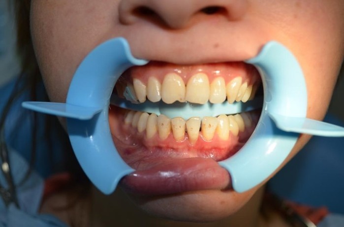 Способы отбелить зубы в домашних условиях без вреда для эмали