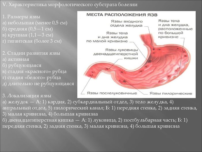 Язва Луковицы Двенадцатиперстной Кишки Диета