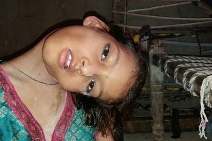 Девочка 9 лет живёт со сломанной шеей. Жизнь под углом 180 градусов