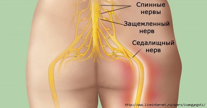 Чем лечить ишиас седалищного нерва в домашних условиях Чем лечить ишиас седалищного нерва в домашних условиях