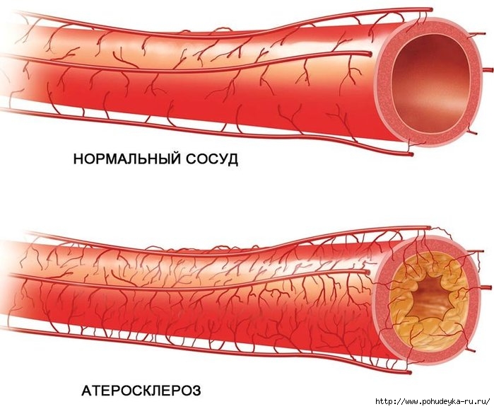 3925073_aterosklerozsosudov (700x578, 184Kb)