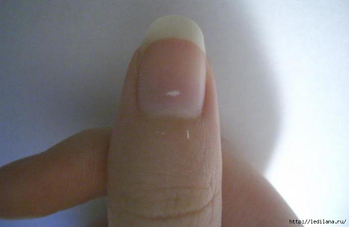 Народные методы лечения белых пятен на ногтях