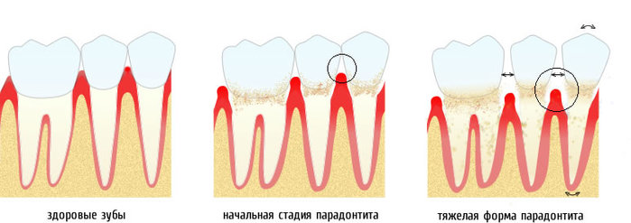 2971058_parodontitis_symptom (700x247, 38Kb)