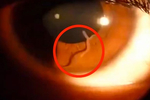 Превью Woman-filmed-with-nematode-worm-inside-her-eye (615x411, 81Kb)