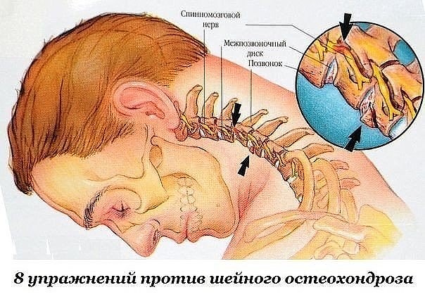 osteohondroz (604x432, 84Kb)