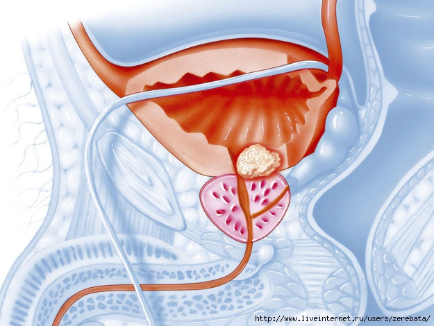 abakterialnyj-prostatit-02 (625x470, 174Kb)