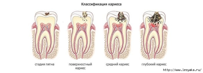 3925073_klassifikaciyakariesa (700x254, 82Kb)