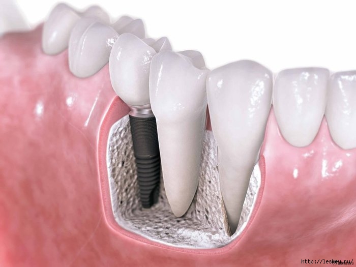1367050891_dental-implants (700x525, 121Kb)