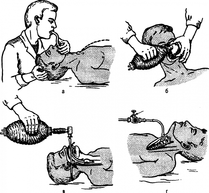 Искусственная вентиляция легких картинки