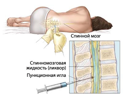 Диагностический метод люмбальной пункции (2) (410x306, 69Kb)