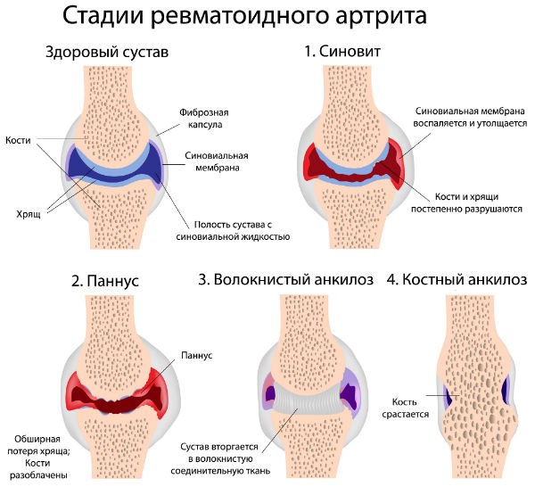 1423250541_KARTOFEL_NA_KEFIRE_PROTIV_ARTRITA (600x555, 61Kb)