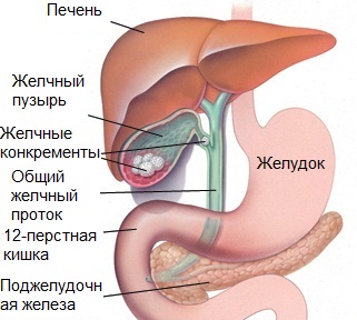 5177462_GallStones (321x288, 70Kb)