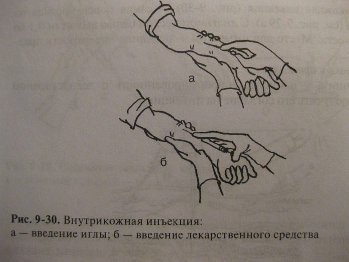 Места постановки внутрикожной инъекции картинки