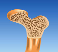 osteoporoz-kostey (204x184, 22Kb)
