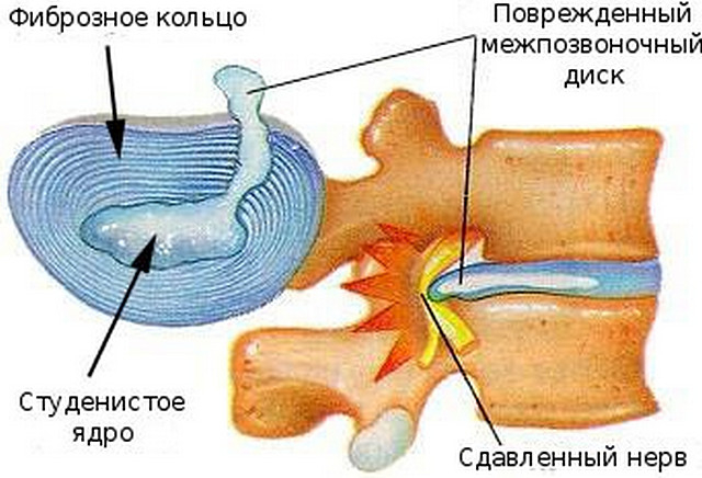 Мр картина дегенеративных изменений грудного отдела позвоночника