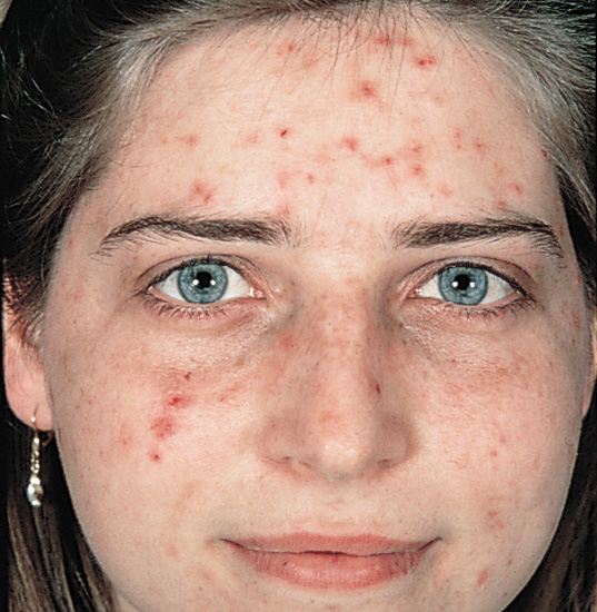 acne (537x550, 282Kb)