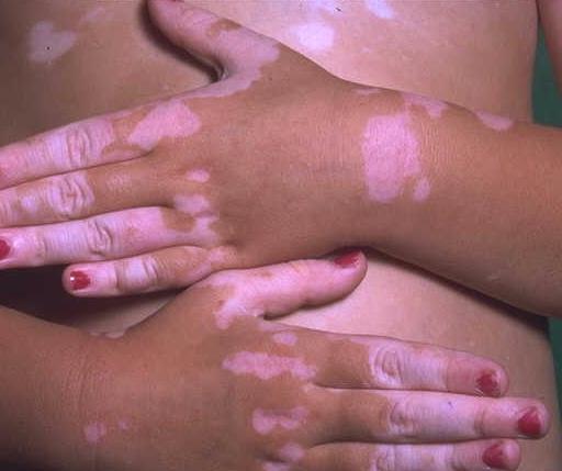 55735897_vitiligo (512x429, 23 Kb)