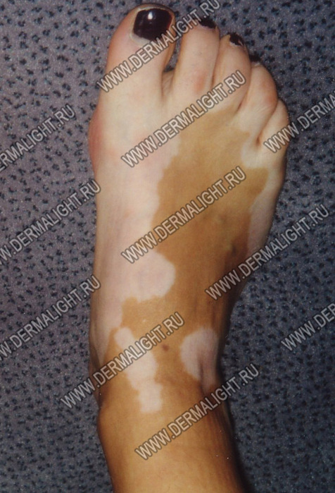 fotografia-vitiligo-6 (476x699, 130 Kb)