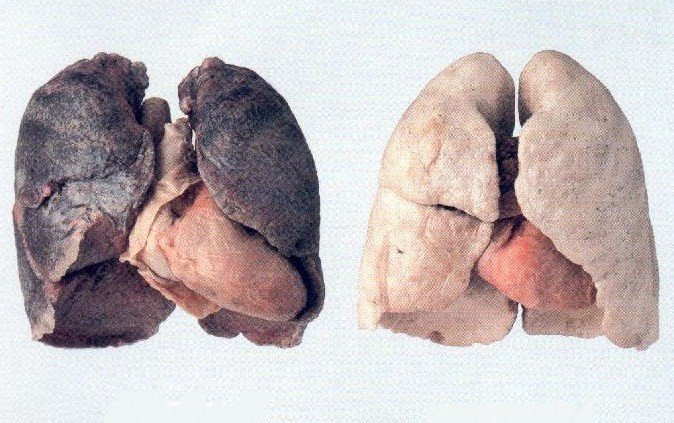 4215787_pulmonsanoypulmondefumador (674x423, 95Kb)