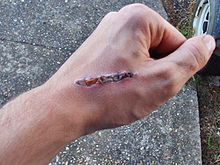 1319318357_220pxAngle_grinder_injury (220x165, 12Kb)