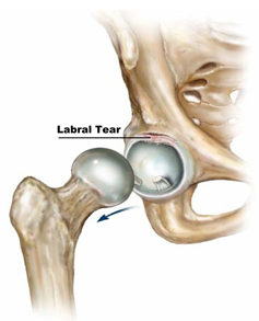 labral-tear (237x293, 32Kb)