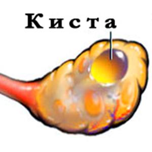 Профилактика кисты