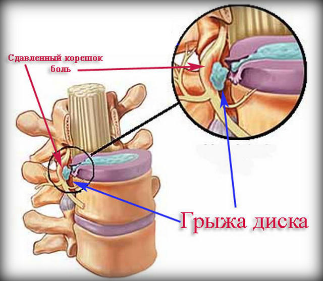 Грыжи дисков. Грыжа диска. Грыжа диска схема.