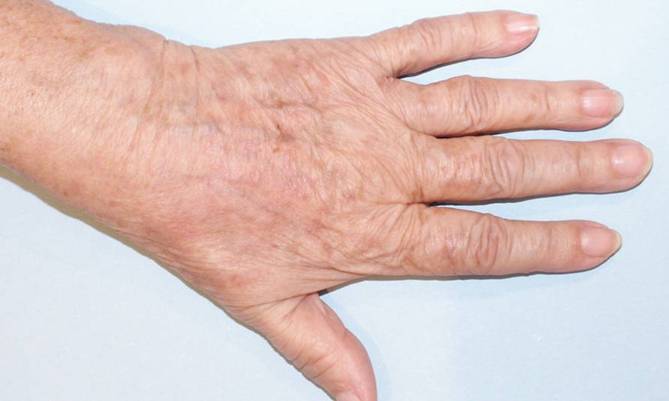 hand_after_1 (669x401, 23Kb)