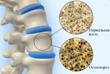 osteoporoz (467x316, 19Kb)