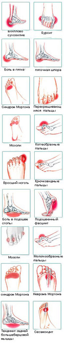 foot-pain (131x700, 44Kb)