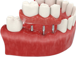 Восстановление зубов за три дня (3) (250x188, 18Kb)