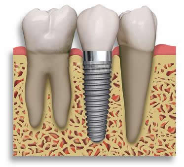 implant_2 (373x339, 20Kb)