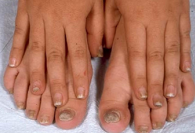 Как лечить грибок ногтей уксусом и йодом, каков будет эффект и через сколько?