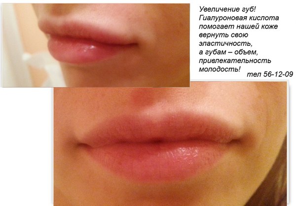Массаж губ после гиалуроновой кислоты
