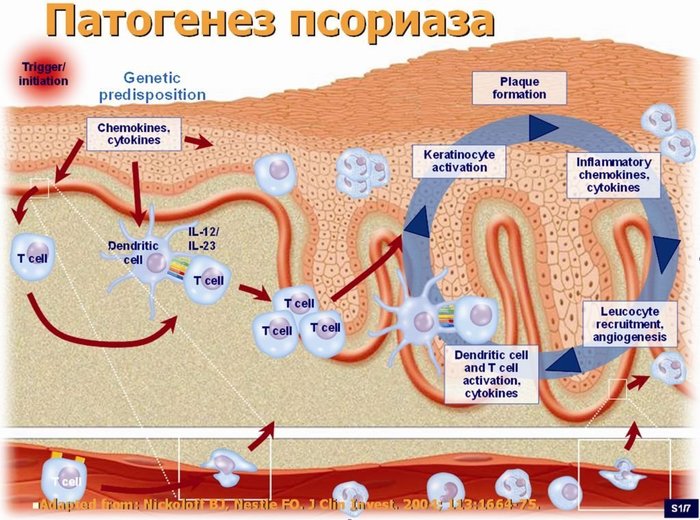 Псориаз иммунология презентация