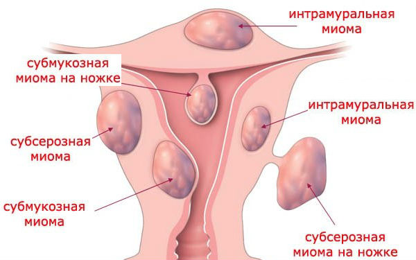 Субмукозная миома. Многоузловая форма миомы матки. Мелкоузловая фибромиома матки.