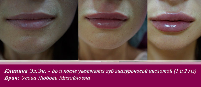 Когда можно пить после увеличения. Увеличение губ гиалуроновой кислотой. Отечные губы после увеличения. Отек после увеличения губ.