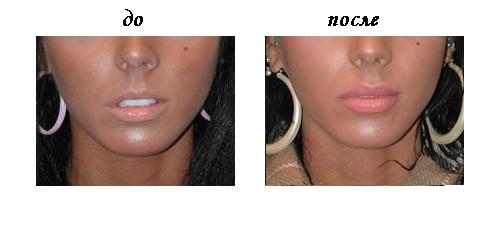Сколько рассасываются губы. Увеличение губ до и после. Губы гиалуроновой кислотой.