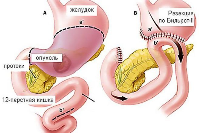 Что такое резекция желудка для похудения