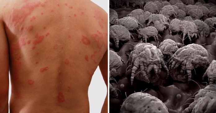 dust-mite-rash-FI-759x419-696x366 (696x366, 146Kb)