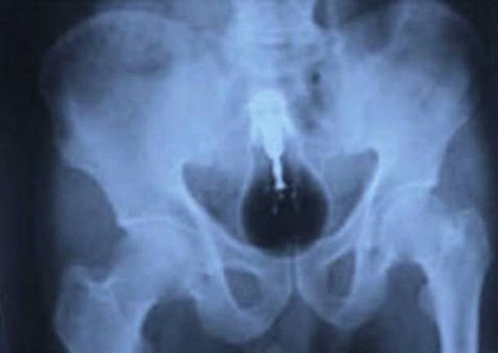 Самые необычные рентгеновские снимки — мобильные телефоны и боевые гранаты внутри пациентов
